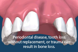 Periodontal disease, tooth loss without replacement, or trauma can result in bone loss and the need for bone grafts.