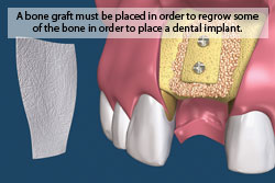 Bone Regeneration