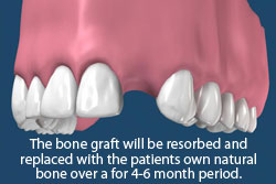 Bone grafts will be resorbed and replaced with the patient's own natural bone over a 4-6 month period. 