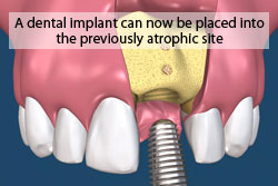 A dental implant can now be placed into the previously atrophic site. 
