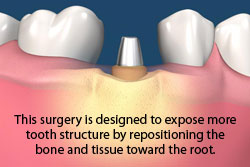 crown lengthening procedure is designed to expose more tooth structure by repositioning the bone and tissure toward the root.