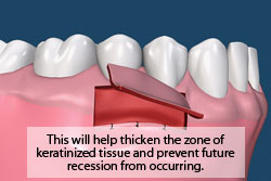 This will help thicken the zone of keratinized tissue and prevent future recession from occurring.