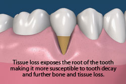 Tissue loss exposes the root of the tooth making it more susceptible to tooth decay and further bone and tissue loss. 