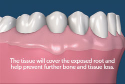 The tissue will cover the exposed root and help prevent further bone and tissue loss.