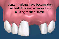 Dental implants have become the standard of care when replacing a missing tooth or teeth.