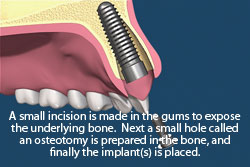 A small incision is made in the gums to expose the underlying bone. Next a small hole called an osteotomy is prepared in the bone, and finally the dental implant is placed. 