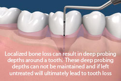 Localized bone loss can result in deep probing depths around a tooth. These deep probing depths can not be maintained and if left untreated will untimately lead to tooth loss.