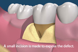 A small incision is made to expose the defect. 