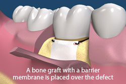 A bone graft with a barrier membrane is palced over the defect. 