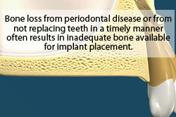 Bone loss from periodontal disease or from not replacing teeth in a timely manner often results in inadequate bone available for implant placement.