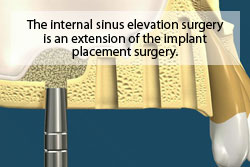 The internal sinus lift surgery is an extension of the implant placement surgery.