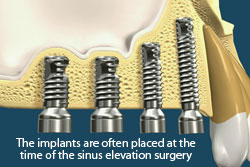 The implants are often placed at the time of the sinus lift surgery.