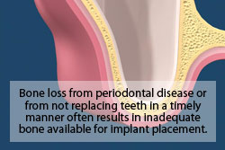 Bone loss from periodontal disease or from not replacing teeth in a timely manner often results in inadequate bone available for implant placement. 