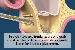 In order to place implants, a bone graft must be placed to reestablish adequate bone for implant placement.
