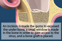 An incision is made to the gums to expose the under bone, a small window is made in the bone in order to gain access to the sinus, and a bone graft is placed.