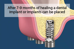 After 7-9 months of healing a dental implant or implants can be placed. 