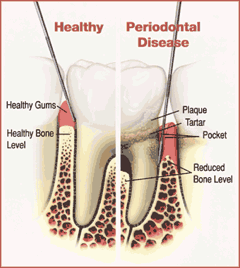 gum disease, periodontal disease