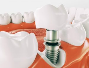 Tooth Implants Fairfield County, CT