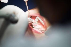 dental implants Fairfield County CT